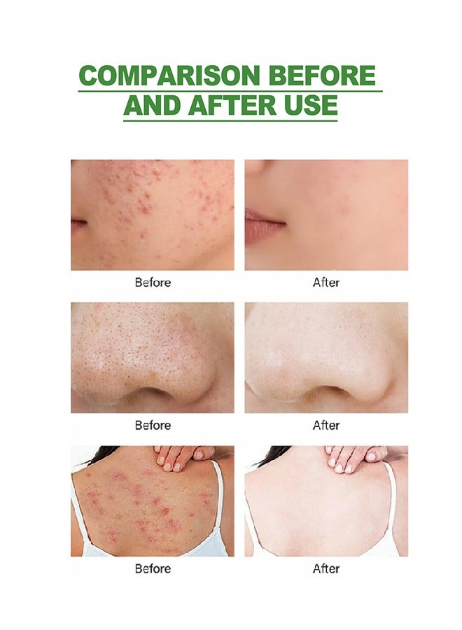 Acne Removal Treatment Cream, Oil Control Acne Removal Acne Pimple Repair Cream, Acne Spot Treatment for Face & Acne Dots, Natural Cystic Acne Treatment Suitable for Oily And Acne Prone Skin 20g