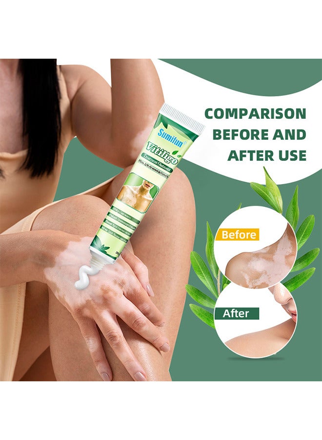 Vitiligo Treatment Ointment, Reduces White Spots On Skin, Pigmentation Regulating, Improve Skin Pigmentation, Reduces White Spots On Skin And Vitiligo Care Cream For Skin Cares, 20G