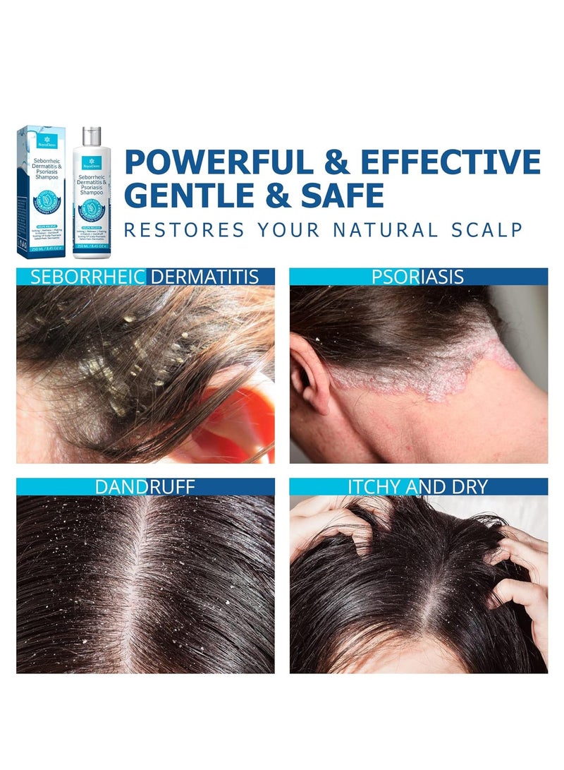 Roycederm Psoriasis Shampoo, Seborrheic Dermatitis Shampoo, Folliculitis Shampoo, Dandruff Shampoo, Scalp Psoriasis & Seborrheic Dermatitis Treatment, Dry Itchy Scalp Treatment