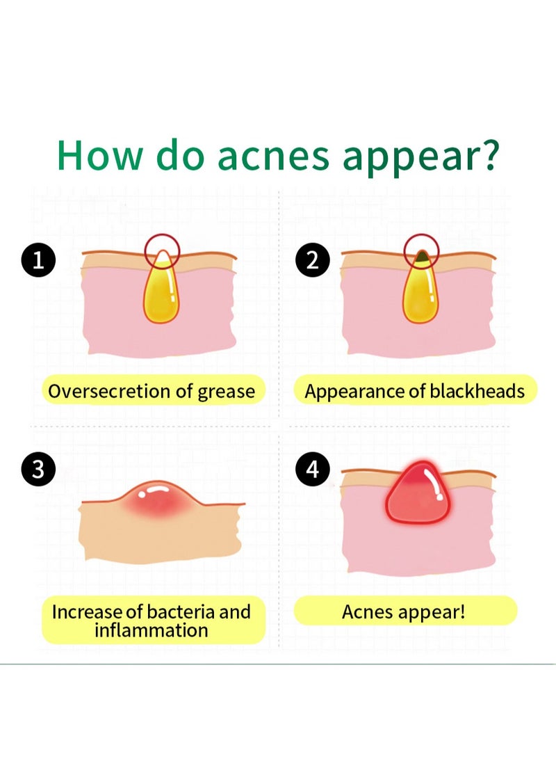 BREYLEE Tea Tree Acne Cream Moisturizing Acne Marks Essence Cream