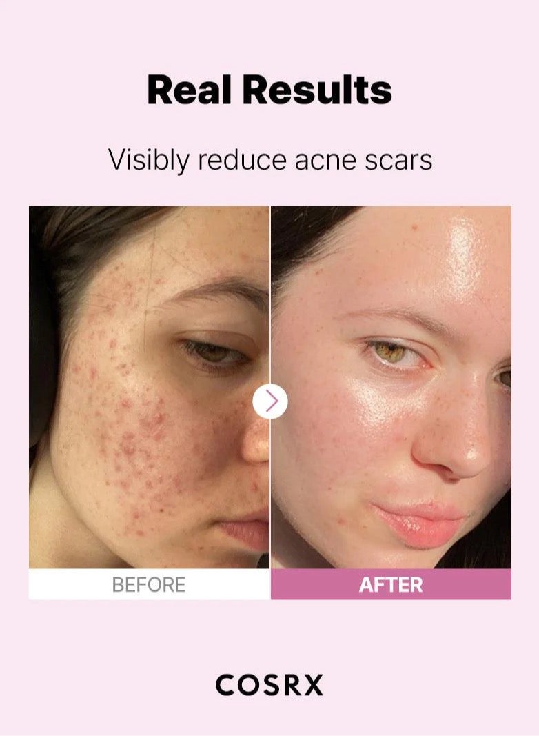 Acne & Pore Care Set Centella Foam Calming Cleanser Power Essence 96 Niacinamide 15% - Your Ultimate Solution for Clear, Radiant Skin 320ml