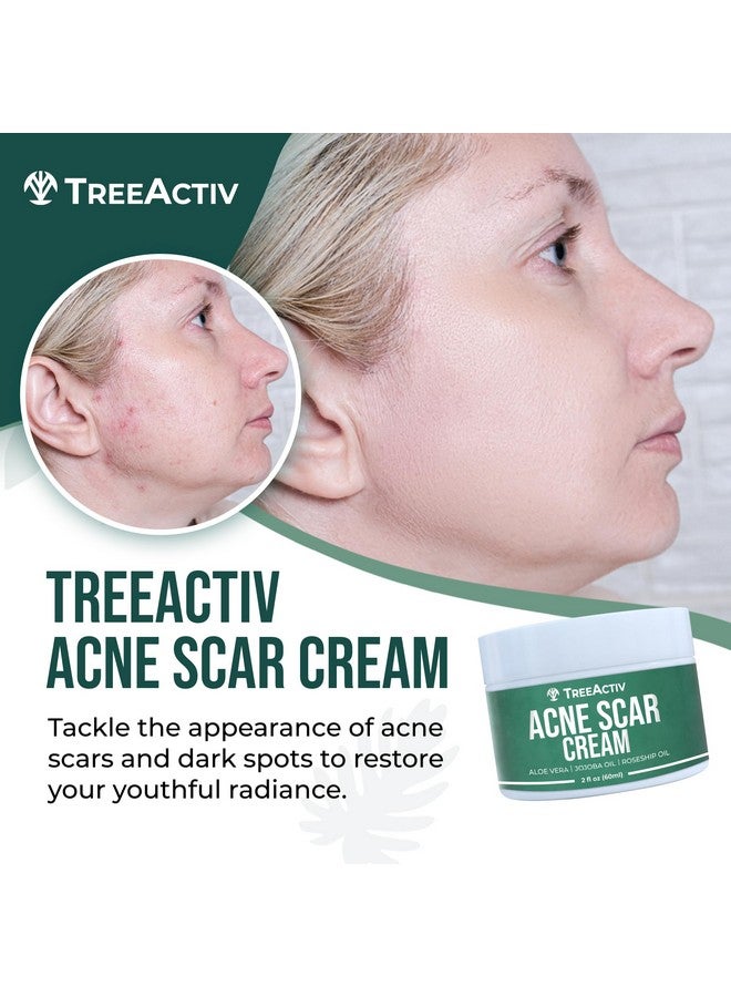 Acne Scar Treatment 2 Fl Oz Acne Scar Cream For Face Gentle Acne Scars And Dark Spot Remover Scar Lotion For Stretch Marks And Body Scars Acne Scar Removal For All Skin Types 500+ Uses