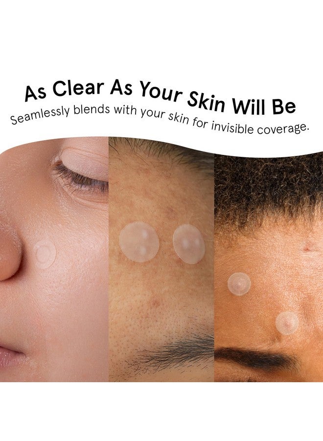 Pimple Patches For Face (Round 36 Count) Hydrocolloid Acne Patches For Face Vegan Crueltyfree Zit Patches For Face Blemish Patches Pimple Stickers Zit Stickers…