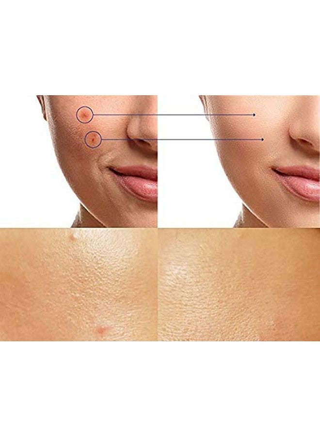 Acne Pimple Patch Hydrocolloid Absorbing Patch Clear Acne Stickers (2 Sheets/40Patchs)