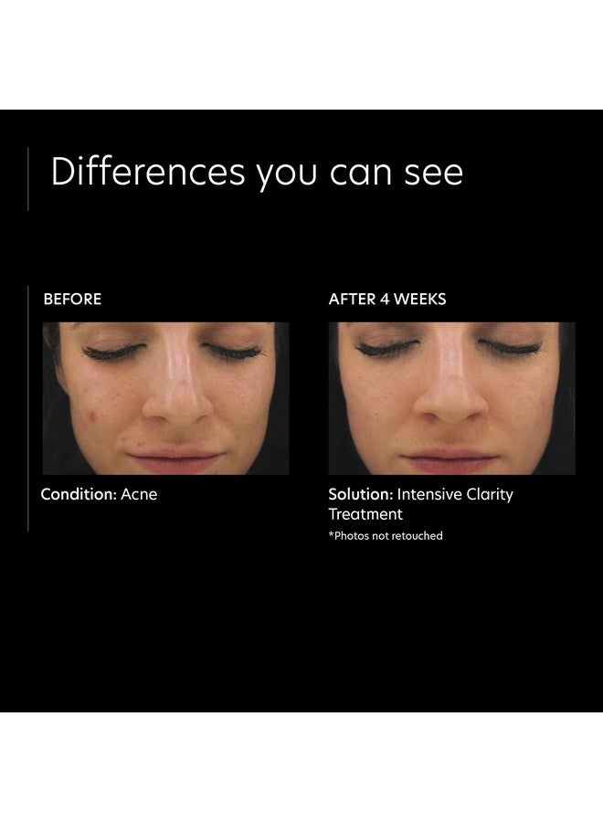 Intensive Clarity Treatment 0.5% Pure Vitamin A Retinol & 2% Salicylic Acid Face Serum For Acneprone Skin (1 Oz)