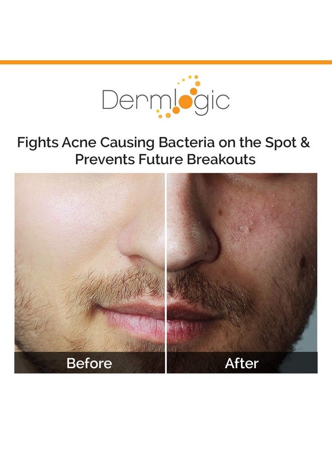 Acne Spot Treatment Overnight Treatment For Whitehead & Blackhead Pimples. Eliminate Cystic Breakouts & Clogged Pores. Clears Away Severe Mild Moderate Blemishes For Teens & Adults. Alcoholfree.