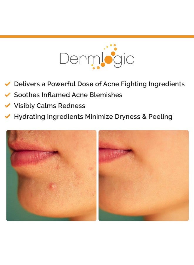 Acne Spot Treatment Overnight Treatment For Whitehead & Blackhead Pimples. Eliminate Cystic Breakouts & Clogged Pores. Clears Away Severe Mild Moderate Blemishes For Teens & Adults. Alcoholfree.