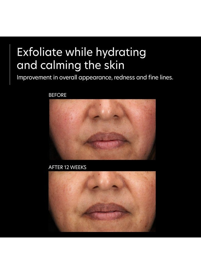 Resurfacing Serum Gentle Exfoliating Facial Corrective With Lactic & Glycolic Acid For Bright Even Skin (1 Fl Oz)