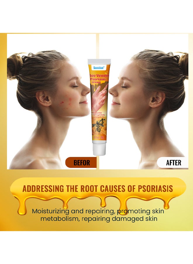 Bee Venom Psoriasis Cream, New Zealand Bee Venom Professional Psoriasis Cream For Itchy Skin Fast Relief Cream For Face And Body, Soothing And Moisturizing Psoriasis Cream 20G