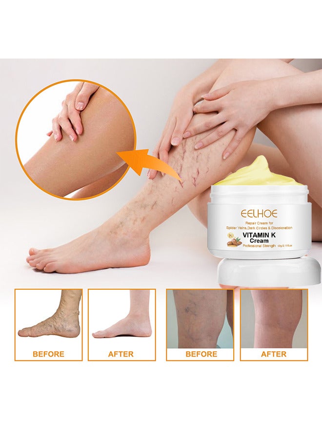 Vitamin K Varicose Veins Cream, Soothing Leg Cream, Varicose And Spider Veins Treatment Cream, Improve Blood Circulation, Fast Relieve Swelling Pain 60G