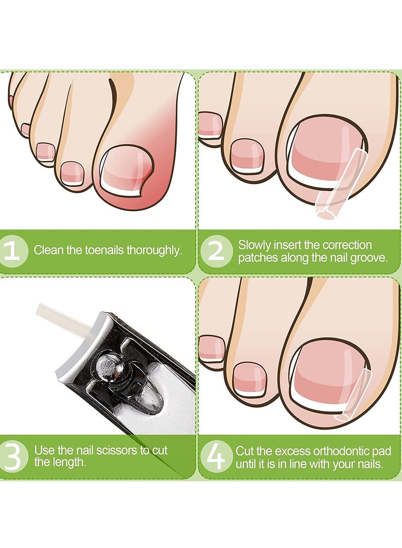Ingrown Toenail Corrector Strips Toenail Correction Patches Curved Toenails Straightening Recover Clips Thick Paronychia Pedicure Tool Toenail Straightener Strip for Men Women Foot Care 100 Pieces