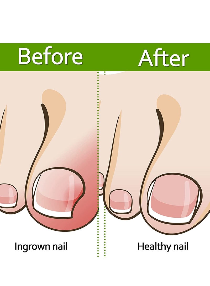 Ingrown Toenail Corrector Strips Toenail Correction Patches Curved Toenails Straightening Recover Clips Thick Paronychia Pedicure Tool Toenail Straightener Strip for Men Women Foot Care 100 Pieces