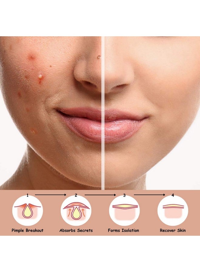 Advanced Acne Pimple Patch Pro For Overnight Healing Hydrocolloid Bandage Effective Gentle & Natural Treatment Acne Patch Fastacting (48 Counts + 2 Chin & 2 Nose Patches)