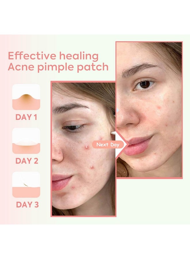 Advanced Acne Pimple Patch Pro For Overnight Healing Hydrocolloid Bandage Effective Gentle & Natural Treatment Acne Patch Fastacting (48 Counts + 2 Chin & 2 Nose Patches)