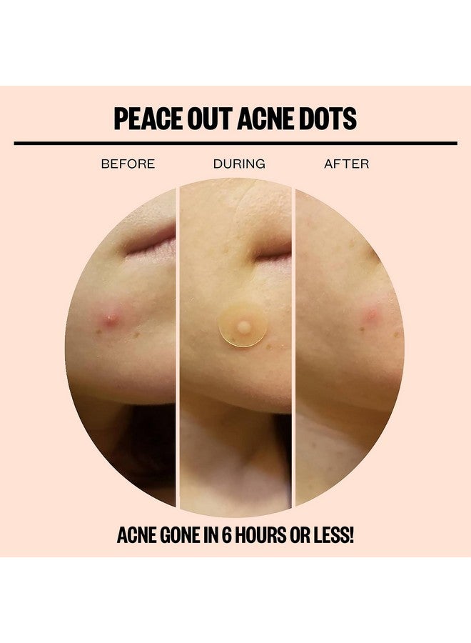 Skincare Acne Dots Hydrocolloid Pimple Patches Help Clear Blemishes Overnight Fast Acting Antiacne Solution (10 Dots)