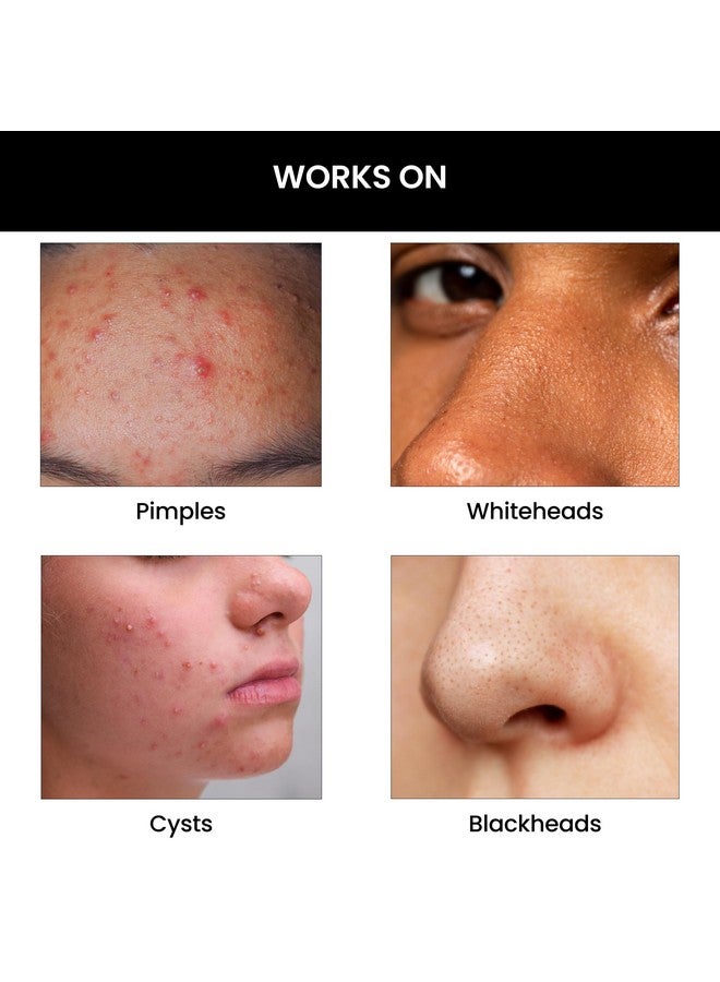 Goodbye Acne Kit Antiacne Serum (30Ml) And Face Wash (100Ml) Reduces Pimples Acne Marks & Sebum Production With Diacnemidetm Azelaic Acid Witch Hazel Niacinamide & Zinc Pca For Women & Men
