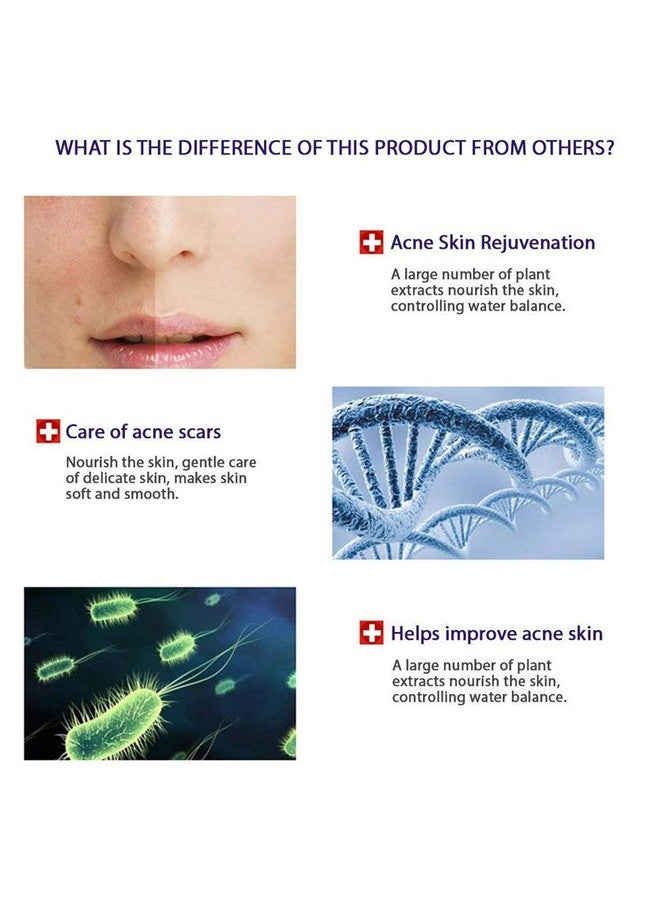 4In1 Face Acne Treatment Scar Removal Spots Pimples Oil Cream Face Masks Scar Blemish Marks Moisturizing Oil 100G+30G+30Ml+4Pcs X30G