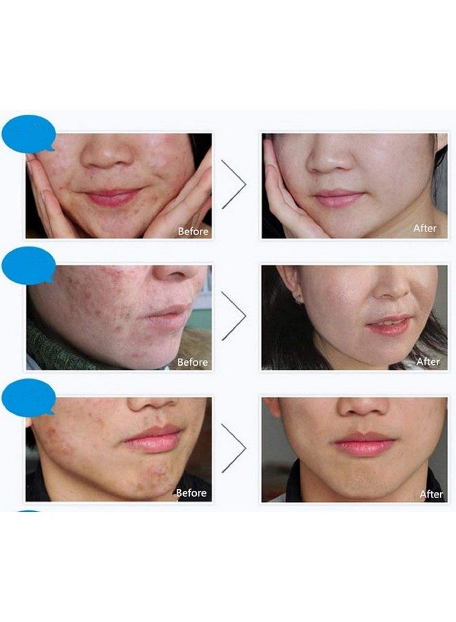 4In1 Face Acne Treatment Scar Removal Spots Pimples Oil Cream Face Masks Scar Blemish Marks Moisturizing Oil 100G+30G+30Ml+4Pcs X30G
