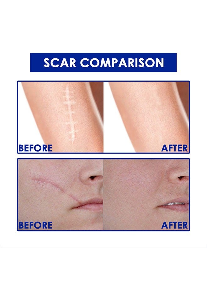 Advanced Formula Scar Gel，Scar Repairing Gel，Helps Soften And Smooth Raised Scars Skin Care Gel, Reduces Discolouration, Redness, Pain and Discomfort of Scars 15g