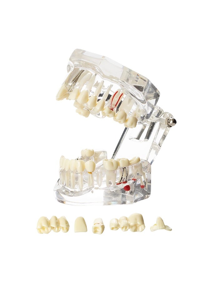 1 Pc Dental Oral Typodont Model Implant Pathological Anatomy Study Removable Teach Demo