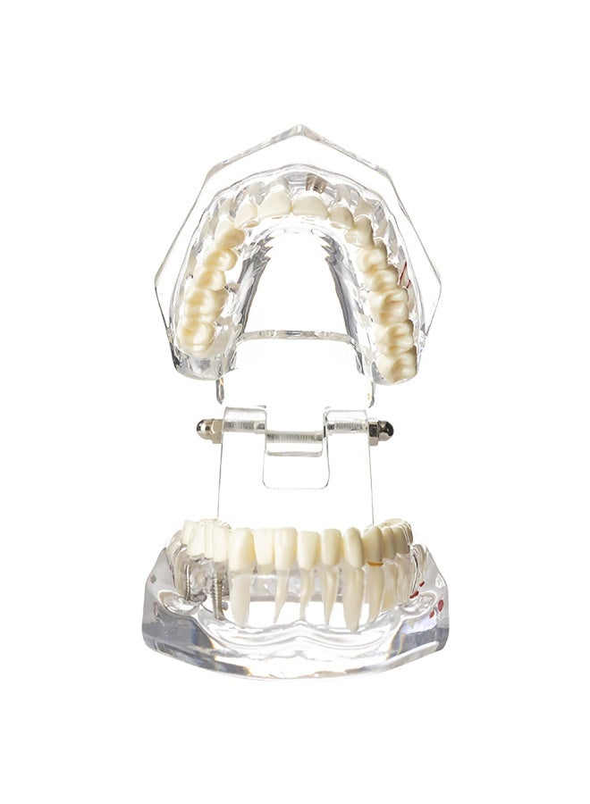 1 Pc Dental Oral Typodont Model Implant Pathological Anatomy Study Removable Teach Demo