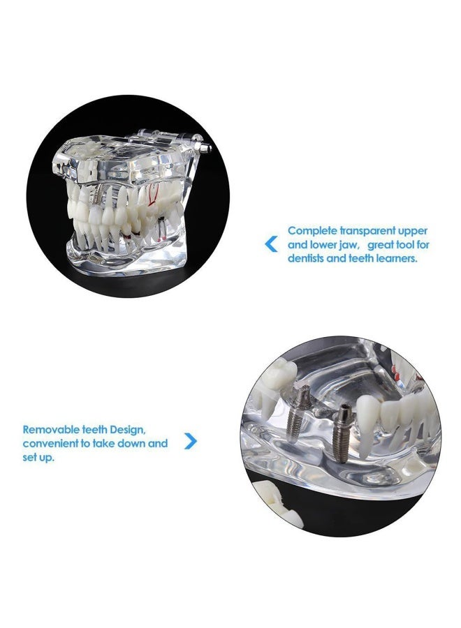 1 Pc Dental Oral Typodont Model Implant Pathological Anatomy Study Removable Teach Demo