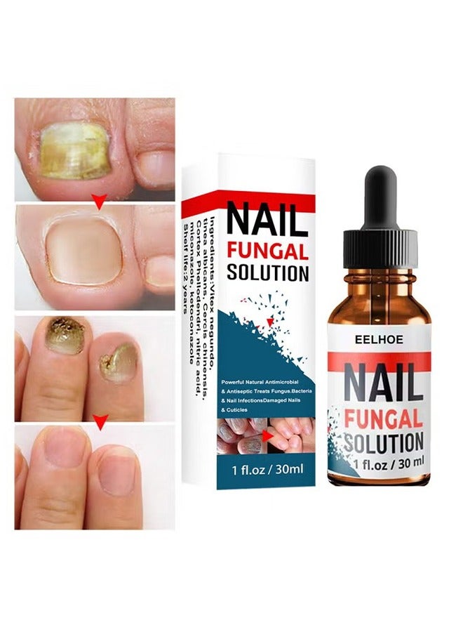 Nail Repair Solution Hand and Foot Nail Fungus Care Repairs Nail Fungus Fluid to Thicken Soft Nails Onychomycosis Care