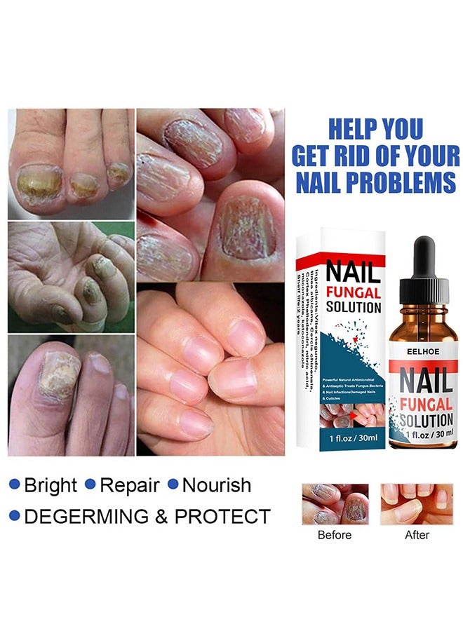 Nail Repair Solution Hand and Foot Nail Fungus Care Repairs Nail Fungus Fluid to Thicken Soft Nails Onychomycosis Care