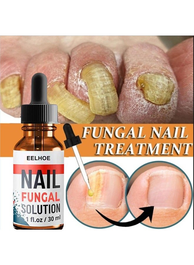 Nail Repair Solution Hand and Foot Nail Fungus Care Repairs Nail Fungus Fluid to Thicken Soft Nails Onychomycosis Care