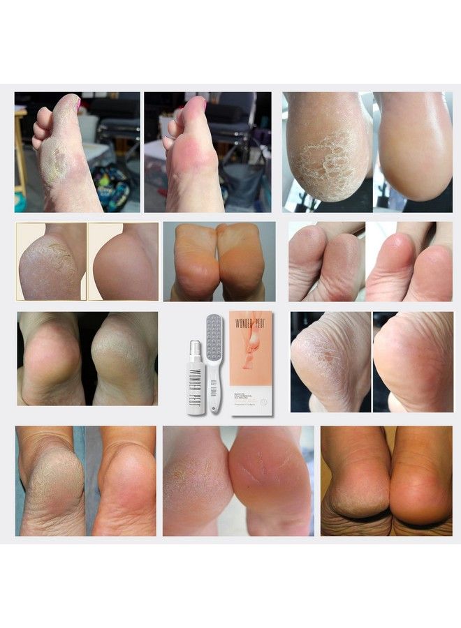 Feet Callus Remover Instant Exfoliating Peel Foot Spray Cracked Heels Softener Metal Foot File Scrubber Dead Skin Remover Professional Spa Pedicure. Wonder Pedi