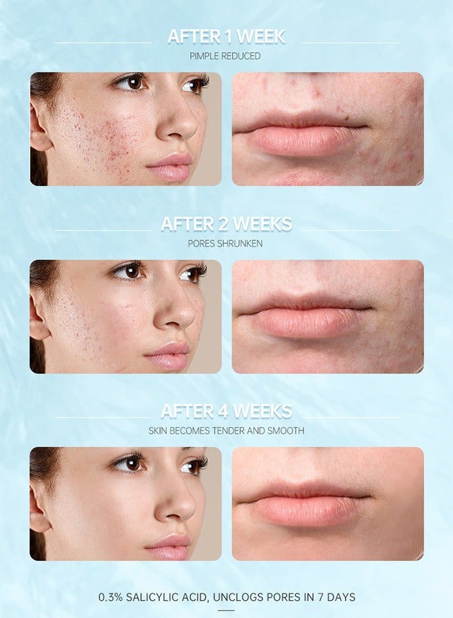 Salicylic Acid Acne Face Cream Whitening Facial Treatment Hyaluronic Acid Black Dots Remove Skin Care Beauty Health Repairing Skin Base Essence 15ml