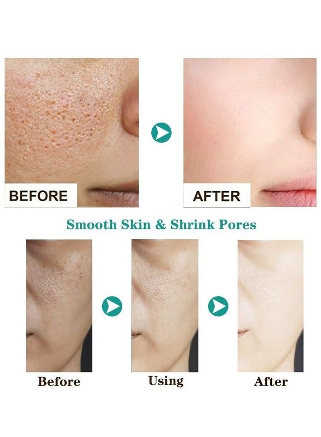 Salicylic Acid Acne Face Cream Whitening Facial Treatment Hyaluronic Acid Black Dots Remove Skin Care Beauty Health Repairing Skin Base Essence 15ml