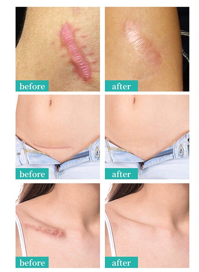 Tratamiento De Las Cicatrices, Advanced Formula Scar Treatment Gel 15g, Helps Soften And Smooth Raised Scars, Maintaining The Moisture Balance of The Adjacent Skin, Reduces Discolouration, Redness, Pa