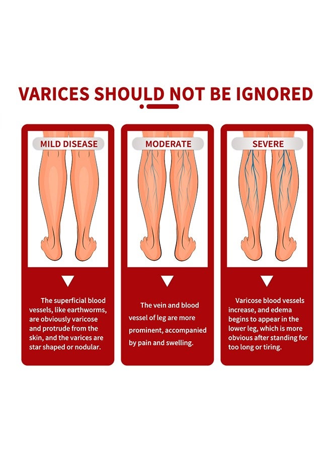 Varicose Veins Cream，Relieve Tired Legs Relieve Dilated Capillaries Minimize Varicose &Spider Veins ​Relief Cream 20g