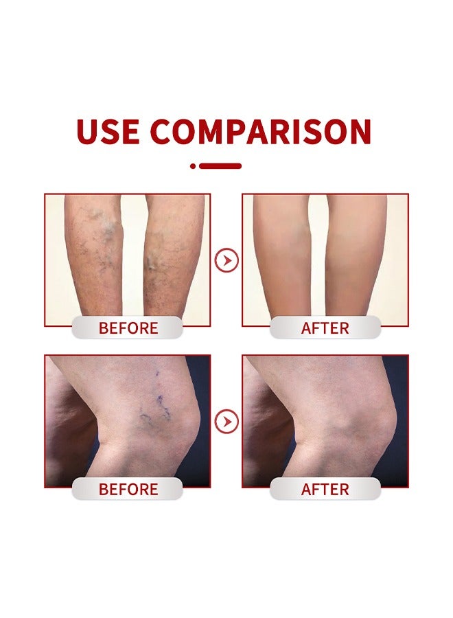 Varicose Veins Cream，Relieve Tired Legs Relieve Dilated Capillaries Minimize Varicose &Spider Veins ​Relief Cream 20g