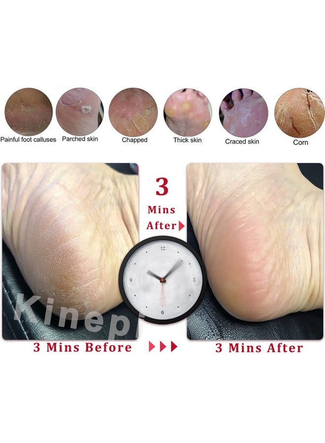 Callus Remover Foot Scrubber Colossal Foot File Foot Care And Foot Exfoliator Foot Rasp Pedicure Tools Pumice Stone For Feetremove Corn Hard Skin Dead Skin For Use In Shower Foot Scraper Kit