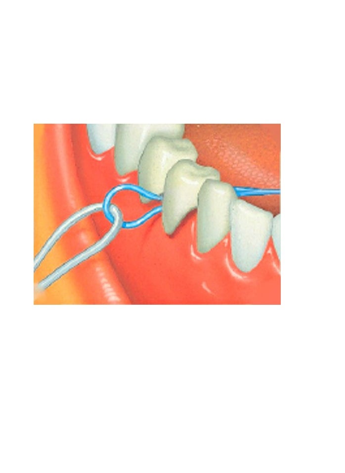 BridgeAid Threaders 10 Packs of 10 (100 Threaders)