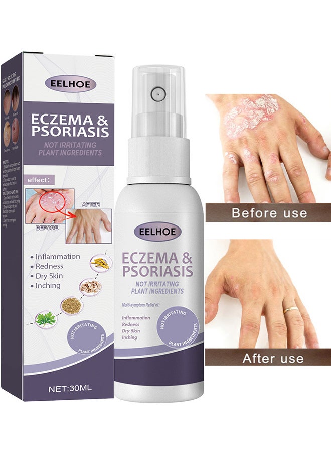 Eczema And Psoriasis Atomizing Spray 30ML, Hand And Foot Moss Skin Repair, Relieve Itching, Skin Care And Jiejia Spray, Antibacterialnot Irritating Safety