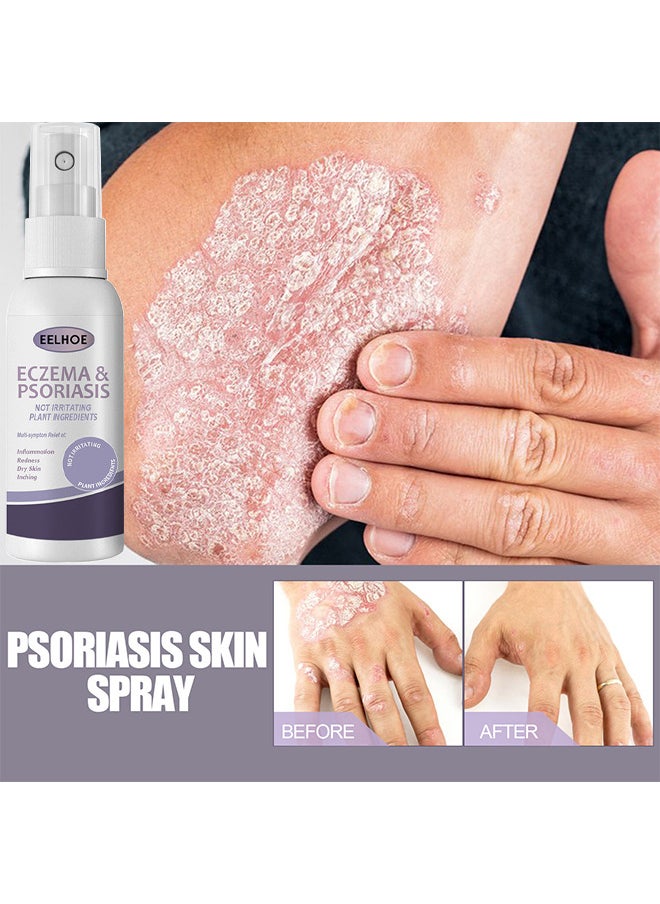 Eczema And Psoriasis Atomizing Spray 30ML, Hand And Foot Moss Skin Repair, Relieve Itching, Skin Care And Jiejia Spray, Antibacterialnot Irritating Safety