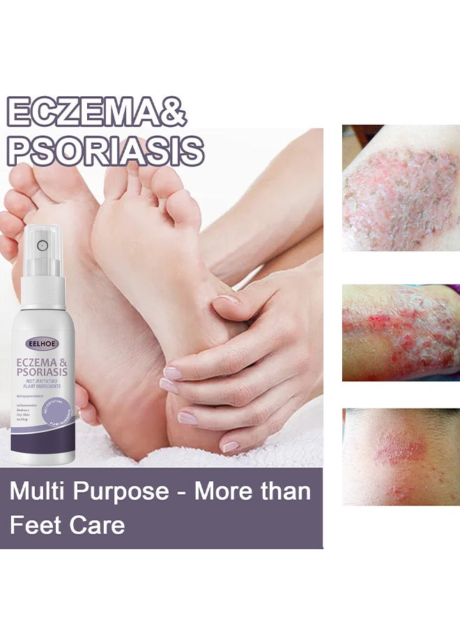 Eczema And Psoriasis Atomizing Spray 30ML, Hand And Foot Moss Skin Repair, Relieve Itching, Skin Care And Jiejia Spray, Antibacterialnot Irritating Safety