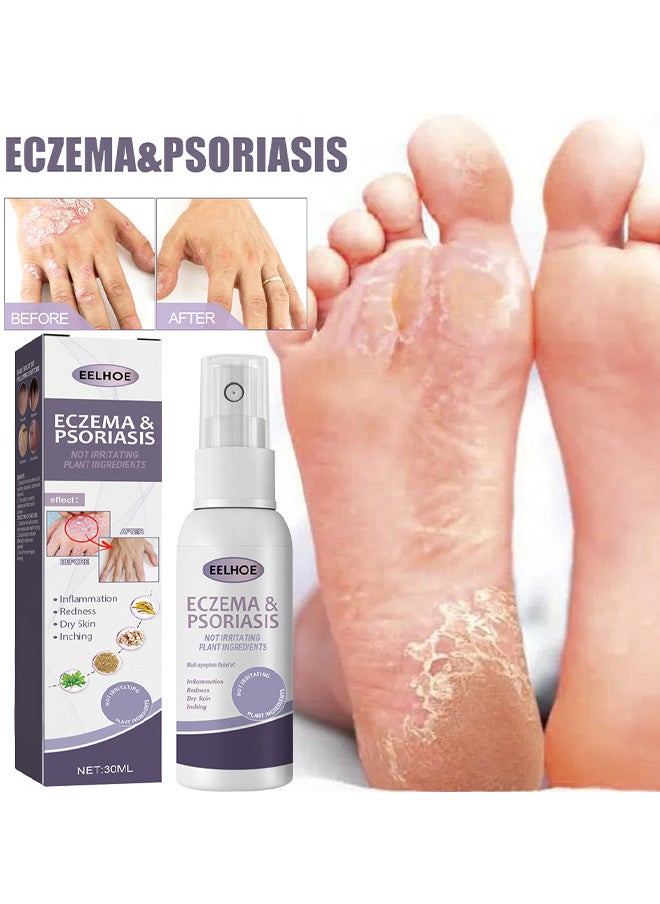 Eczema And Psoriasis Atomizing Spray 30ML, Hand And Foot Moss Skin Repair, Relieve Itching, Skin Care And Jiejia Spray, Antibacterialnot Irritating Safety