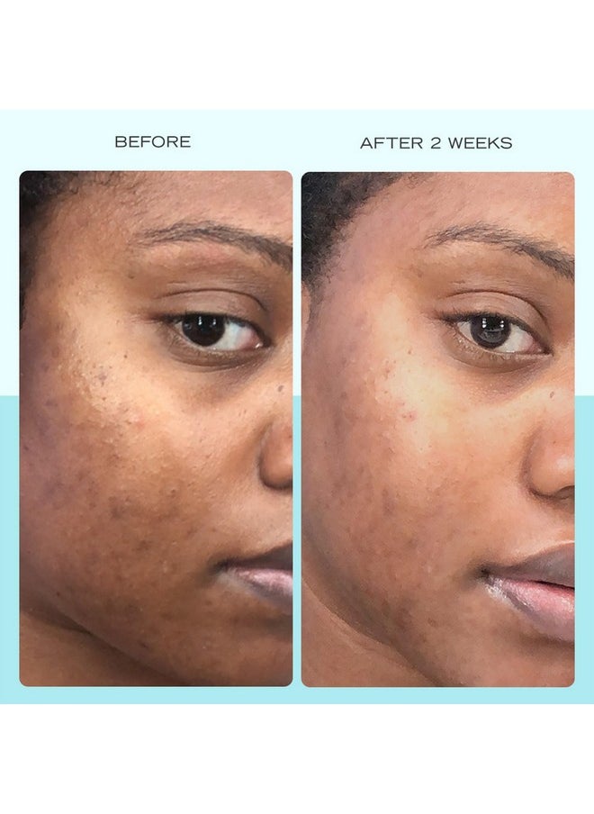 First Aid Beauty - Dark Spot Serum with Niacinamide, Helps Reduce Look of Dark Spots, Sun Spots, Hyperpigmentation, Discoloration & Post-acne marks, Non-Comedogenic, Safe for Sensitive Skin, 1 oz