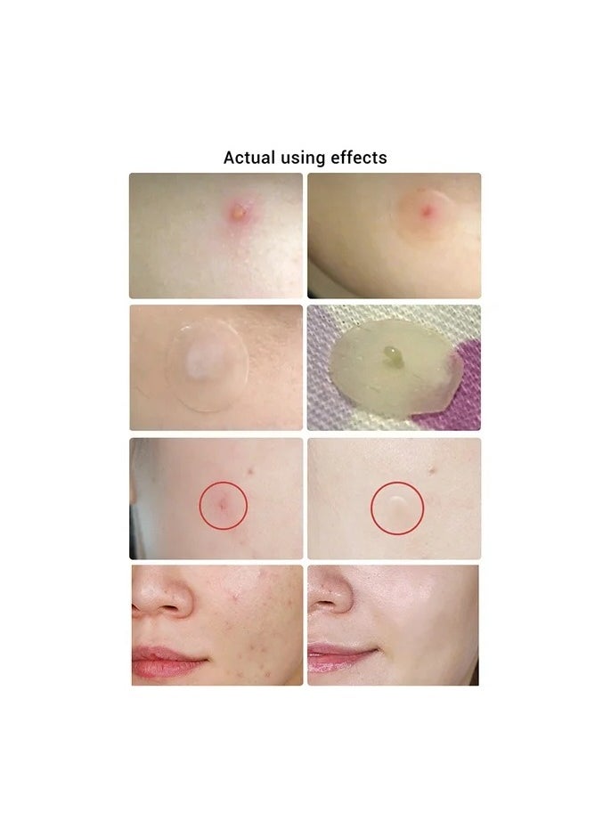 Acne Pimple Patch Acne Removal Acne Stickers Blemish Treatment Face Skin Care Pimple Remover Tool 25 Patches for Daily Use 2 Pack