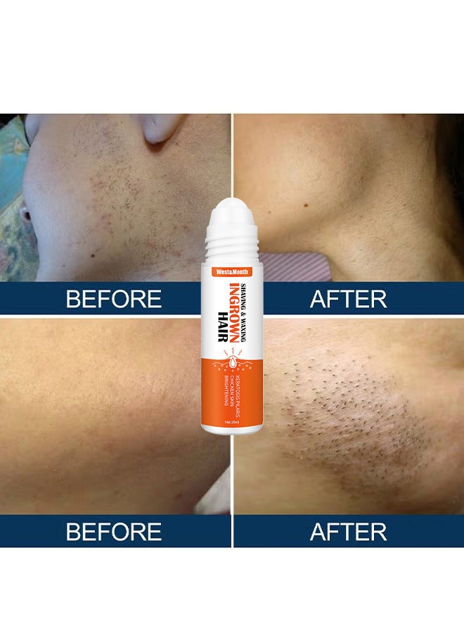 Ingrown Hair Essence Brightening Skin Get Rid Of Beard Nursing Essential Oils, Repairing Serum To Reduce Dark Spots After Shaving Gentle On Ingrown Hair