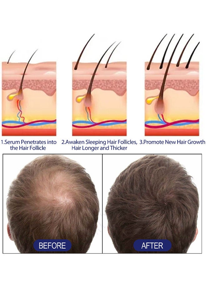 Men's Hair Regrowth Treatment Foam, For Thinning Hair, Hair Follicle, Hair Revitalizes With Topical Aerosol Revitalizes, Nurturing Scalp And Effective Hair Thickening For Men, 60G