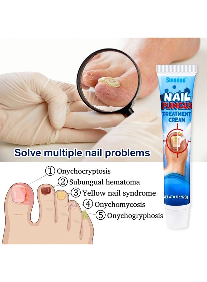 Nail Fungus Treatment Cream, Bad Nail Care Ointment, Nail Fungus Treatment, Nail Growth and Repair, Nail Treatment Repair Cream  20g