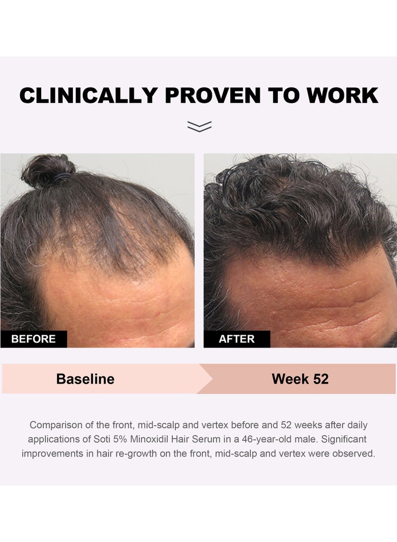 Soti Minoxidil 5% Hair Growth, Hair Loss Regrowth Serum 60ml. Made in USA! Dermatologists Recommended. Ginseng and Biotin Extra Strength Formula (1 Pack)