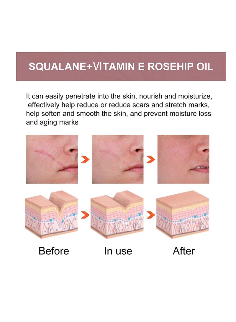 Squalane Vitamin E Rosehip Oil Fade Scars Repair Skin Essential Oil