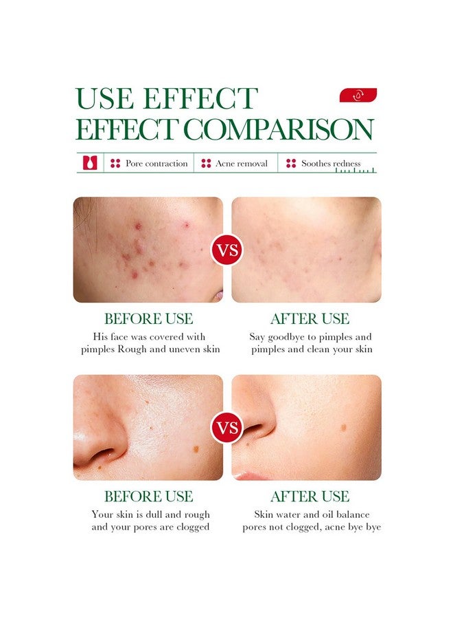 Salicylic Acid Acne Removal Essence Shrinks Pores Soothing Redness Fade Acne Marks 35Ml / 1.23Fl.Oz