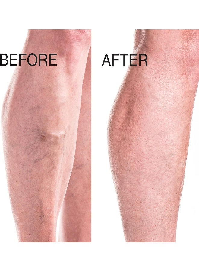 Vein CareEliminate The Appearance Of Varicose Veins. Spider Veins. Guaranteed Results! (Two 8Oz)